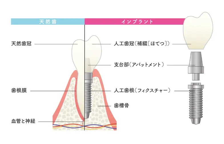 インプラントとは
